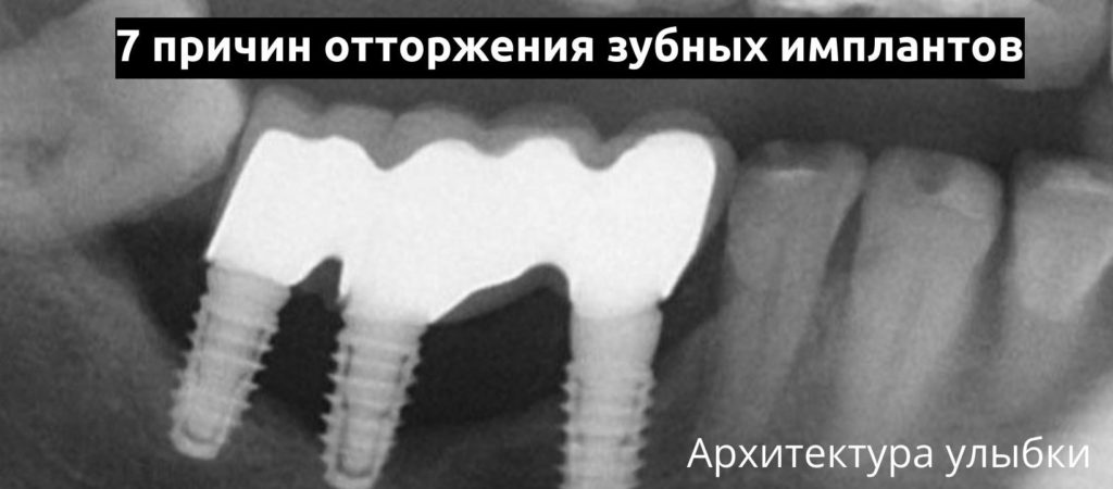 Семь причин оторжения зубных имплантов