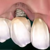 Какие зубные импланты приживаются лучше
