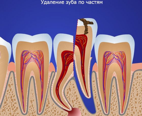 разъединение корней зуба